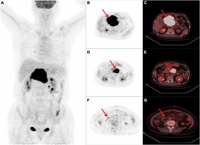 18F-FDG PET/CT assists the diagnosis of primary pancreatic lymphoma: Two case reports and literature review